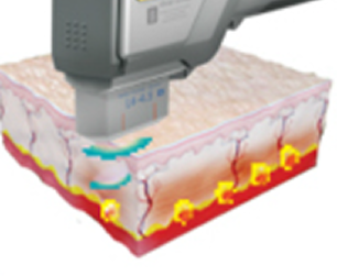 4.5mm 깊이의 SMAS에 열응고점 형성