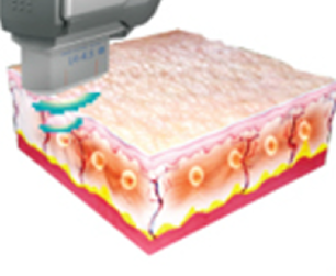3mm 깊이의 진피층에 열응고점 형성